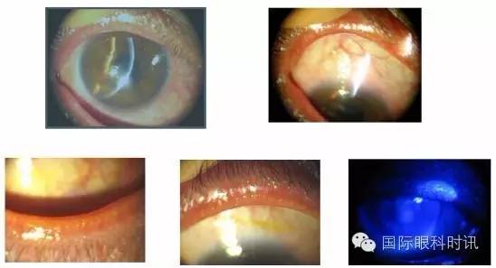 角膜会2016陈百华教授：角膜上皮损伤相关疾病的治疗策略