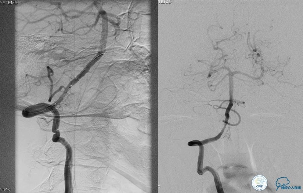 椎基底动脉闭塞严重吗怎么治疗,椎基底动脉局部闭塞微创手术