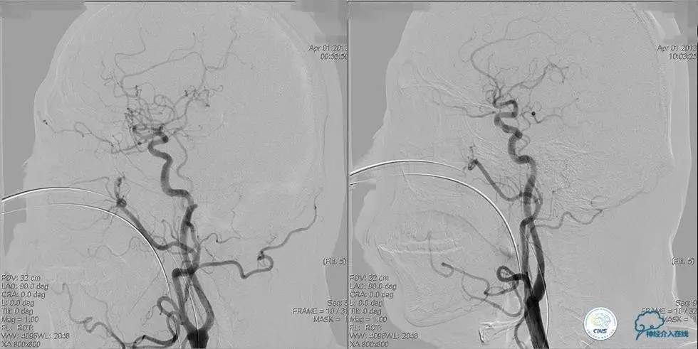 椎基底动脉闭塞严重吗怎么治疗,椎基底动脉局部闭塞微创手术