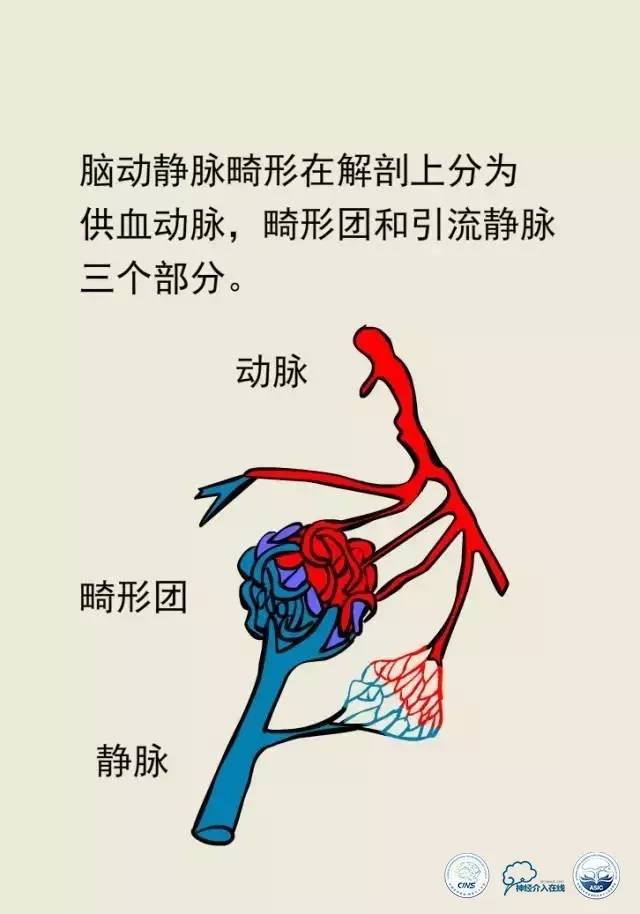 熊猫医生阿缪：脑动静脉畸形怎么破