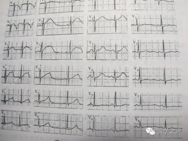 心电图显示t波高尖qt间期延长,心电图显示qt间期延长怎么回事