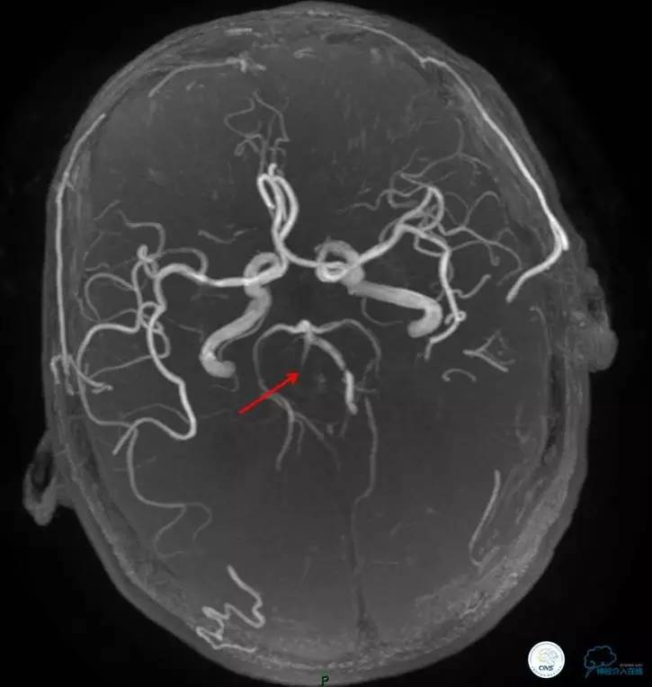 椎基底动脉闭塞严重吗怎么治疗,椎基底动脉局部闭塞微创手术