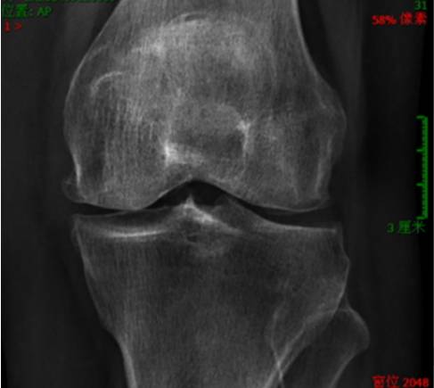 医生科普膝关节疼必须要静养吗,膝关节炎如何诊治比较好