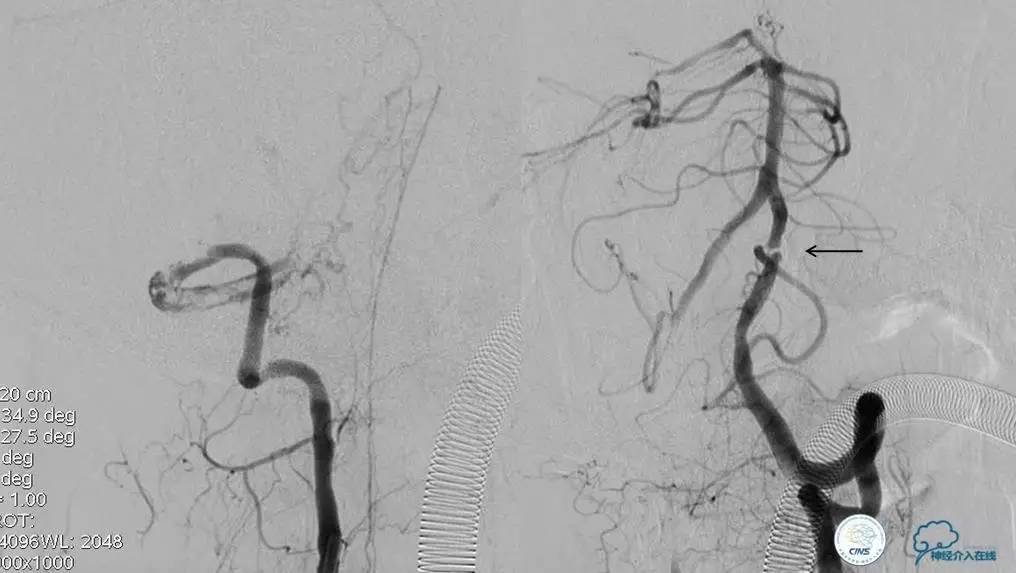 椎基底动脉闭塞严重吗怎么治疗,椎基底动脉局部闭塞微创手术