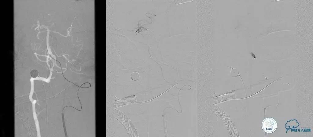 椎基底动脉闭塞严重吗怎么治疗,椎基底动脉局部闭塞微创手术