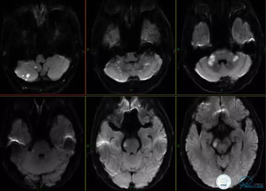 椎基底动脉闭塞严重吗怎么治疗,椎基底动脉局部闭塞微创手术