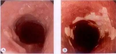 食管癌早期筛查手段,早期食管癌内镜的切除方式有哪些