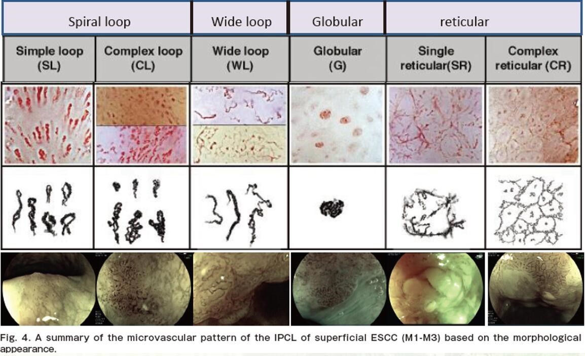食管癌早期筛查手段,早期食管癌内镜的切除方式有哪些