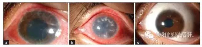 文摘速递棘阿米巴角膜炎：糖皮质激素禁区？