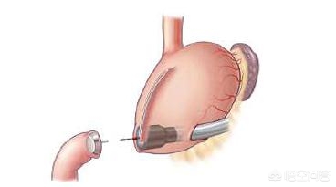 手术后腹部左右大小不一样,腹部手术切口位置