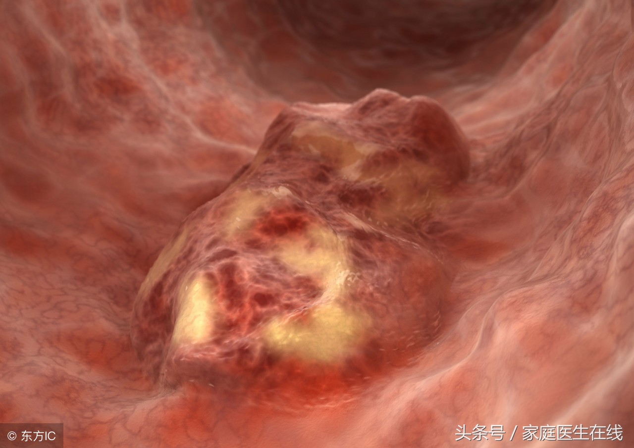 一个月吃方便面身体的变化,吃一个月的方便面会有什么病