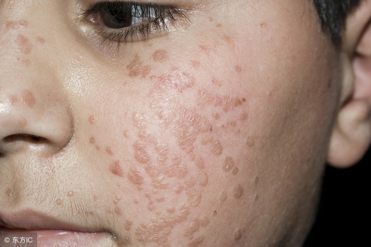 扁平疣好转的表现,扁平疣喝中药好转的反应