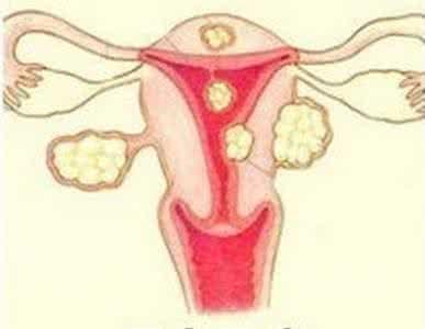 瘢痕子宫关注事项,瘢痕子宫厚2mm关注什么