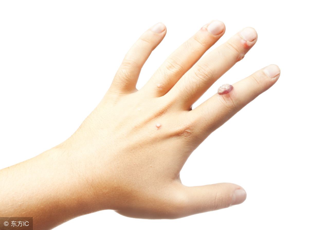 扁平疣好转的表现,扁平疣喝中药好转的反应