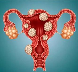 小肌瘤要看良性还是恶性么,子宫两个肌瘤多大需要剔除