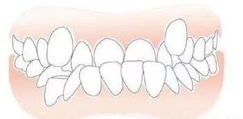 6岁小孩长出28颗牙齿,两排牙齿的孩子图片
