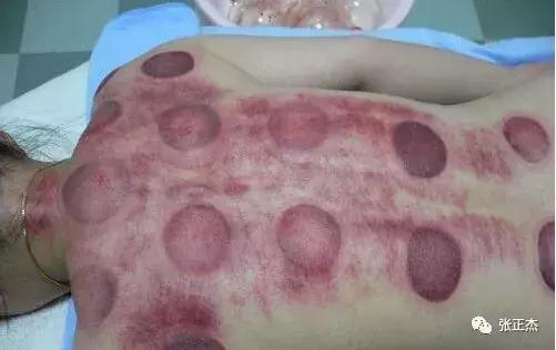 拔罐后皮肤颜色，反应出身体健康的不同问题