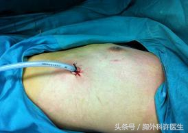 胸腔镜手术会很痛吗,胸腔镜手术很痛吗