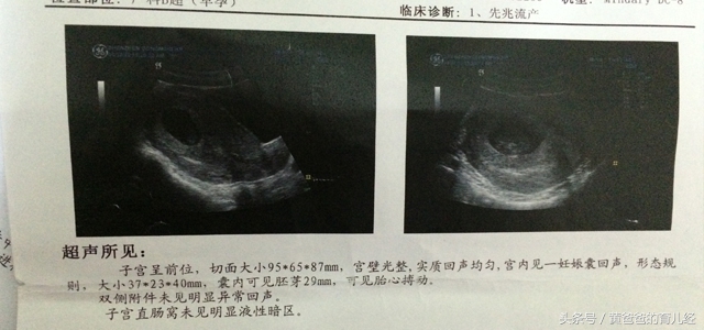 孕期想检查羊水是否正常,孕期看化验单