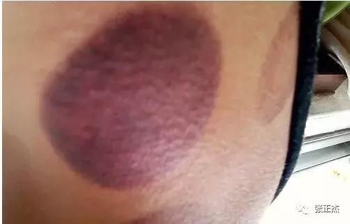 拔罐后皮肤颜色，反应出身体健康的不同问题