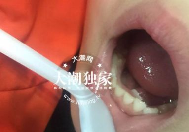 6岁小孩长出28颗牙齿,两排牙齿的孩子图片