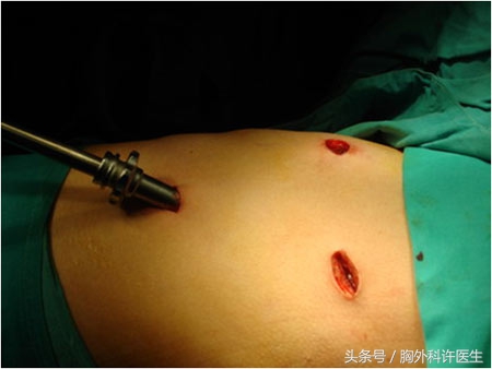 胸腔镜手术会很痛吗,胸腔镜手术很痛吗