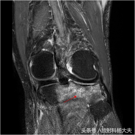 骨挫伤和骨折核磁能分辨出来吗,打球膝盖扭伤需要做磁共振吗