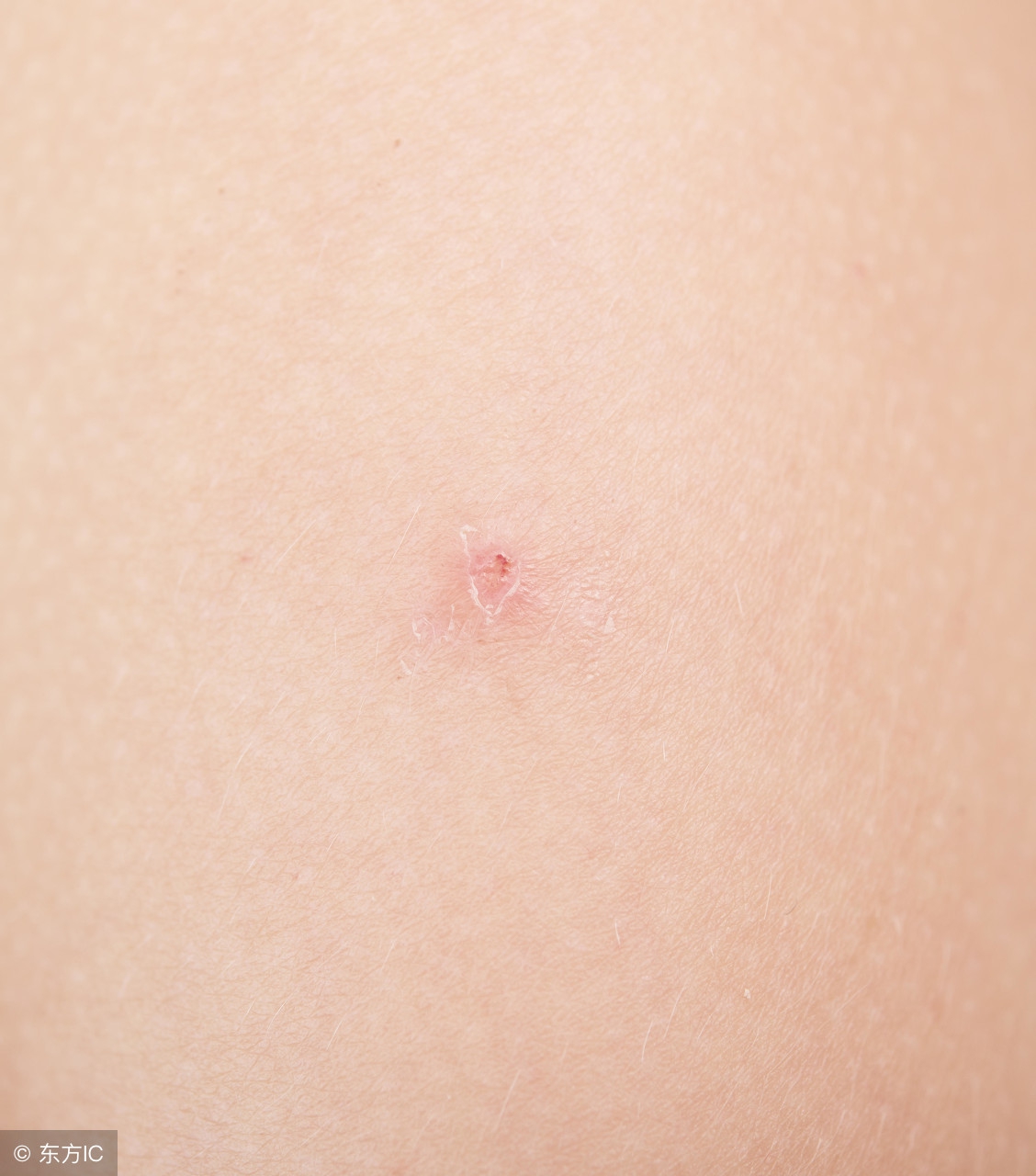 过敏性皮肤病治疗,过敏性皮肤病治疗很麻烦