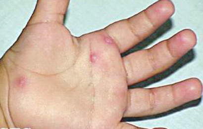 手足口病严重的有没有危险,手足口病第几天最危险