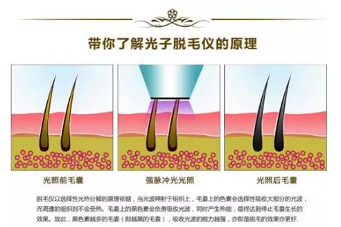 脱毛方法哪种最好女生,脱毛方法哪种最好不用脱毛膏