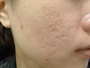 痘痘科普视频,痘痘知识科普祛痘印