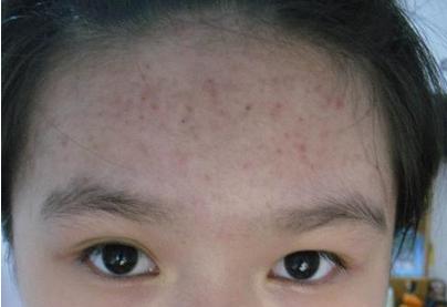 如何才能使脸美白去痘印,怎么快速一夜之间祛痘