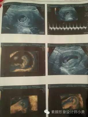 孕育学堂,怀孕九周发烧对胎儿发育有影响吗