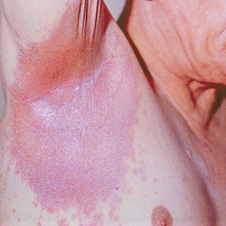 疾病常识：什么是反向性银屑病