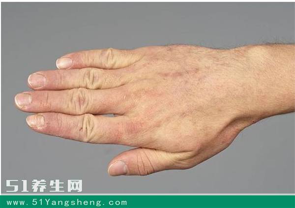 身上手上长红疙瘩很痒是什么原因,游泳后身上起红疙瘩很痒能自愈吗