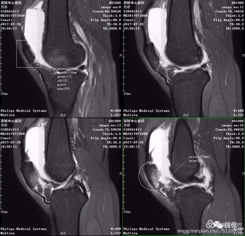 膝关节创伤性积脂血症的临床表现,创伤性积脂血症什么意思
