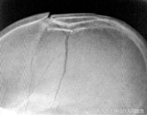 颅骨线性骨折是轻伤吗,小孩颅骨骨折会痊愈吗