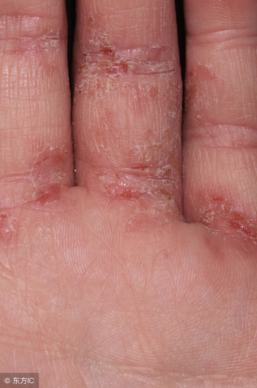 过敏性皮肤病治疗,过敏性皮肤病治疗很麻烦