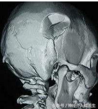 颅骨线性骨折是轻伤吗,小孩颅骨骨折会痊愈吗