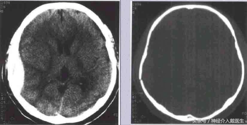 颅骨线性骨折是轻伤吗,小孩颅骨骨折会痊愈吗