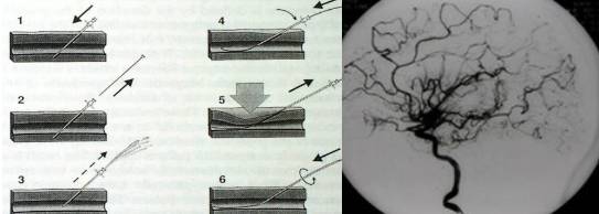 火视231|CookMedical：不断创新血汗管介入治疗器械