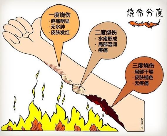 把“冰醋酸”当“饮料”喝，导致严重烧伤？『刘长伟』