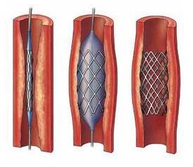 火视231|CookMedical：不断创新血汗管介入治疗器械