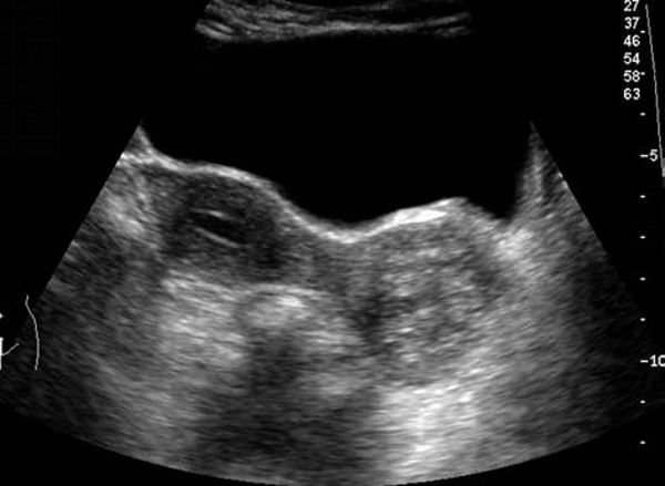 宫颈癌超声病例,宫颈癌手术病理单怎样看懂