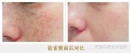 脸上长雀斑是什么原因男生,脸上长雀斑和黄褐斑怎么办