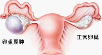 怀孕初期有囊肿会导致流产吗,小小的囊肿可以消失吗