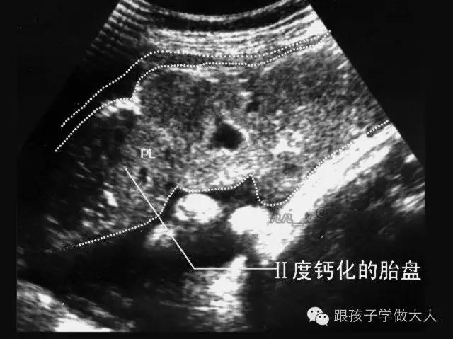 超过预产期了怎么才能让宝宝出生,过预产期还不生怎么办