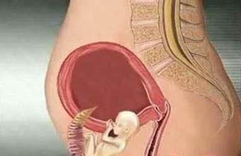 什么是宫外孕它的危害往往没你们想的那么简单