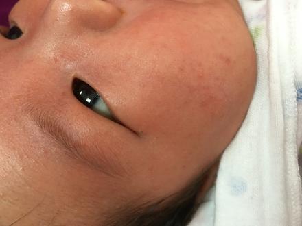 湿疹痱子都有的婴儿该怎么办,宝宝湿疹痱子用什么药膏