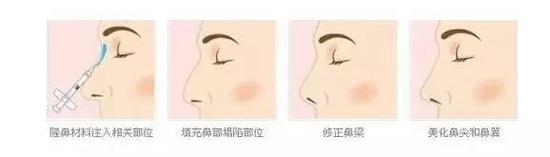 鼻整形有黄金阶段吗,怎么提高鼻子整形成功率